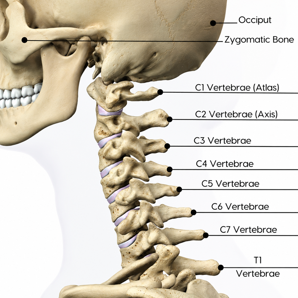 Cervical PIVD Overview